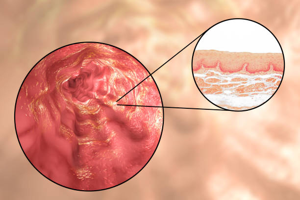 Candidiasis Esof Gica Tienes Que Saber Esto