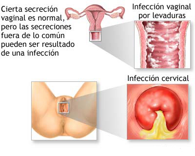 candidiasis crónica vaginal ilustración