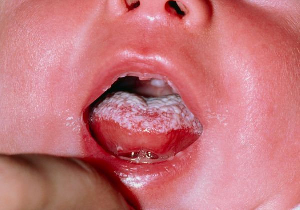 candidiasis oral o muguet en bebés