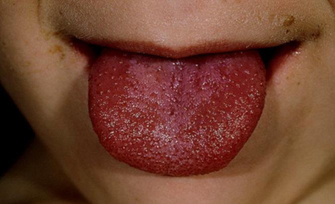 candidiasis eritematosa lengua enrojecida