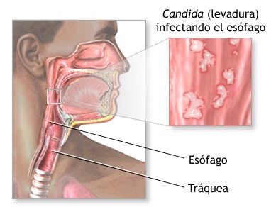candidiasis esofágica explicación ilustrada