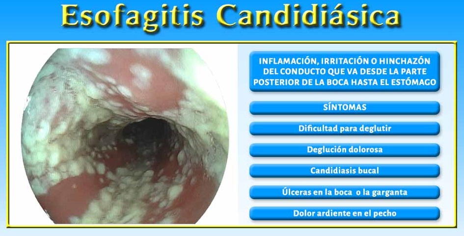 síntomas candidiasis esofágica