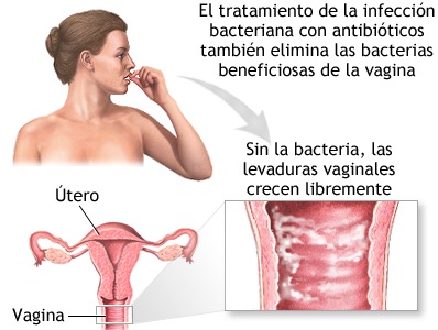 candidiasis genital vagina mujer