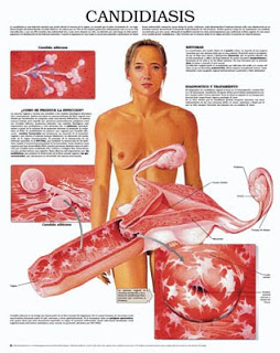 candidiasis genital vagina ilustración