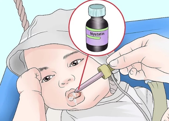candidiasis oral ilustración tratamiento bebés