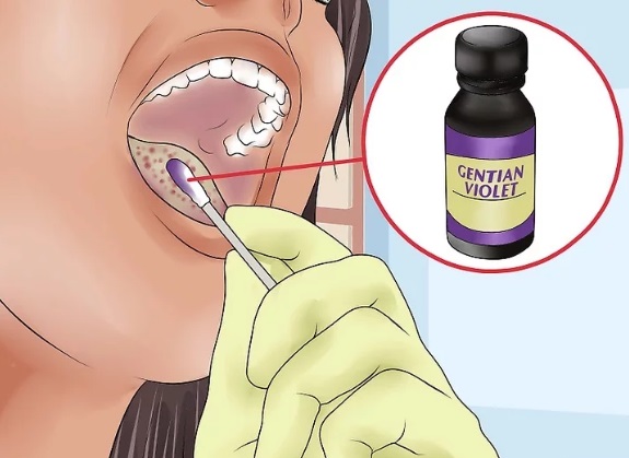 medicamento ilustración candidiasis bucal