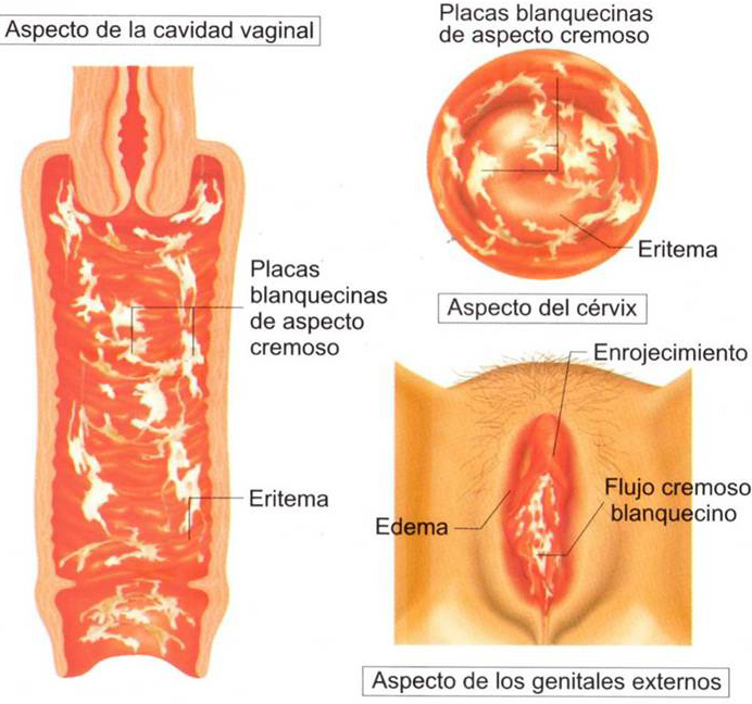 candidiasis recurrente vaginal ilustración