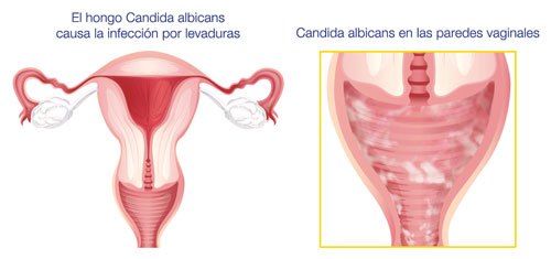 candidiasis recurrente en genitales femeninos