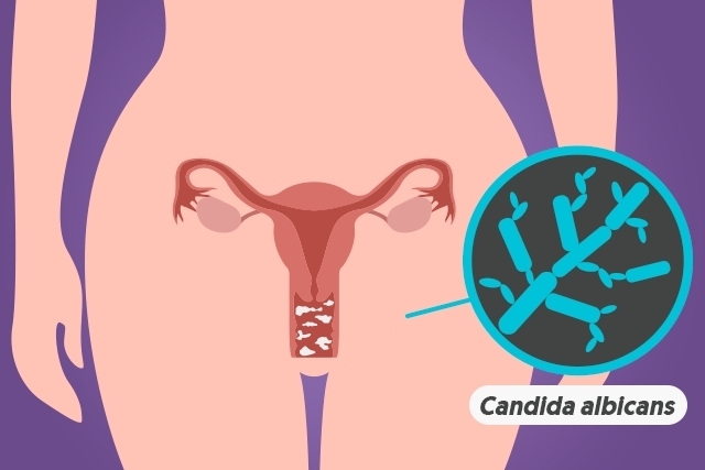 candidiasis vaginal ilustración candida albicans