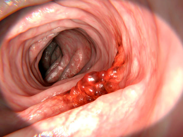 aspecto candidiasis intestinal