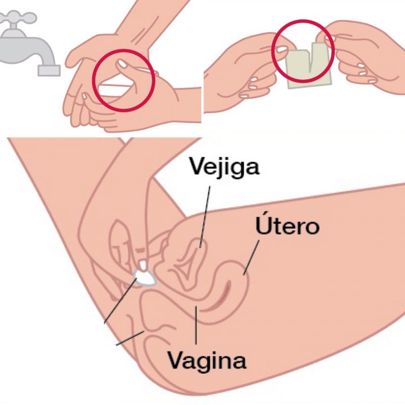 aplicación de los óvulos vaginales para candidiasis